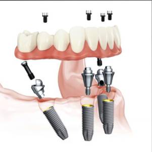 Dental Implants