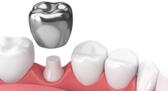 DENTAL CROWNS