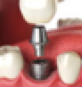 dental implants