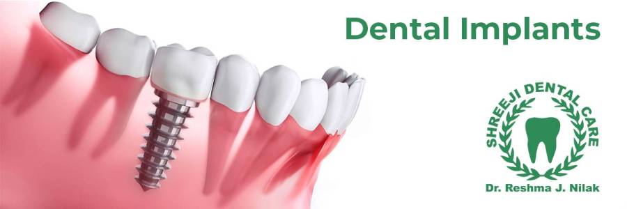 Dental Implants