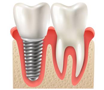 Root Canal Treatment