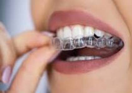 ALIGNERS
