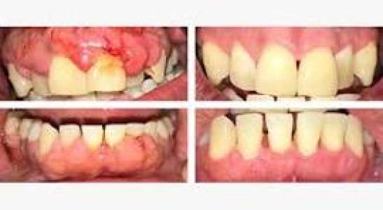 dental implants