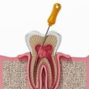 Root Canal Treatment