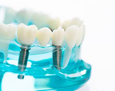 Dental Implants In Vadodara