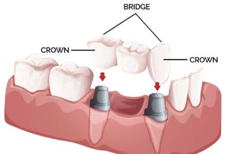 Teeth Bridge Treatment In Vadodara