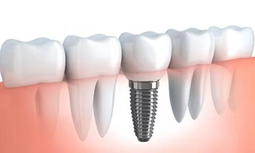 dental implants