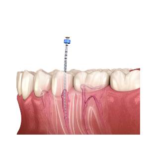 Root Canal Treatment