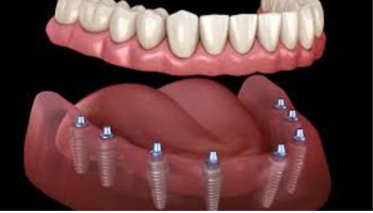 Dental Implants