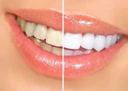 Teeth Whitening and Cleaning
