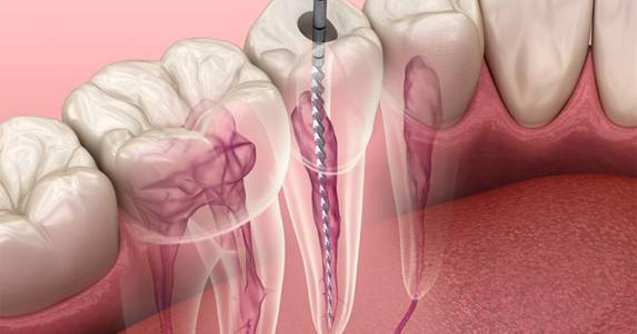 Fillings and Root Canal Treatment