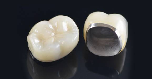 Dental Crown Treatment