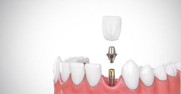Dental Implant Treatment