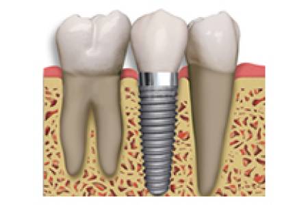 ROOT CANAL TREATMENT
