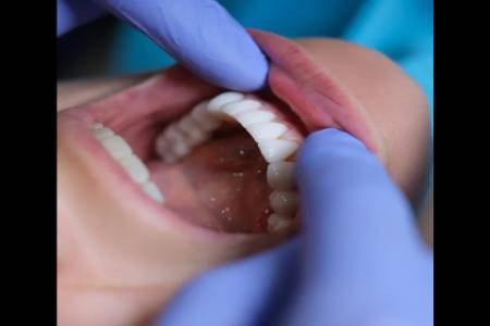 ORAL CANCER CHECKUP & BIOPSY