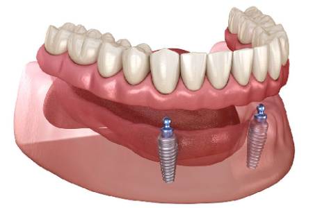 IMPLANT SUPPORTED OVER DENTURE