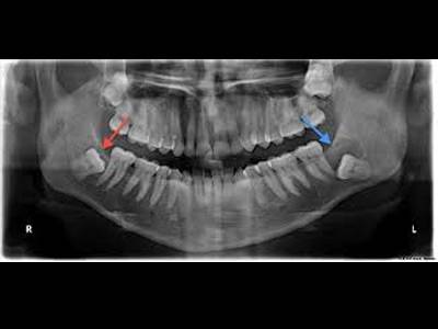 Wisdom tooth surgery