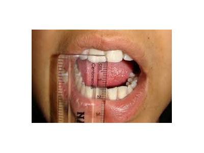 Treatment for reduced mouth opening