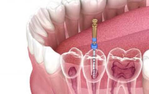 Root Canal Treatment