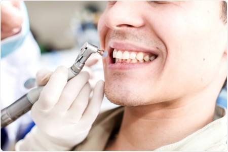Tooth Polishing