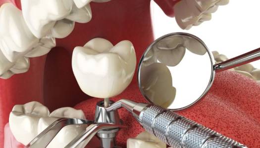 dental implants