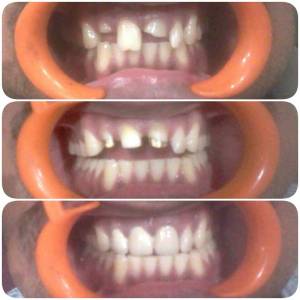 Treatment of Broken Teeth