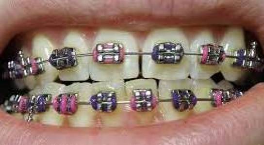 Braces