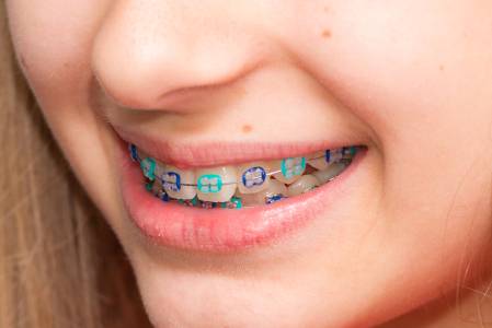 Brace/Invisible Aligners