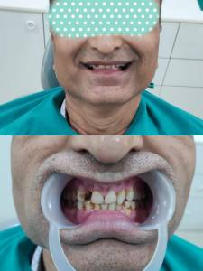Smile Design/Smile Makeover