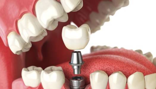 Dental Implants