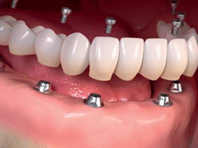 Dental Implants