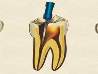 Re-root Canal Treatment