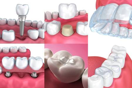 Full Mouth Reconstruction