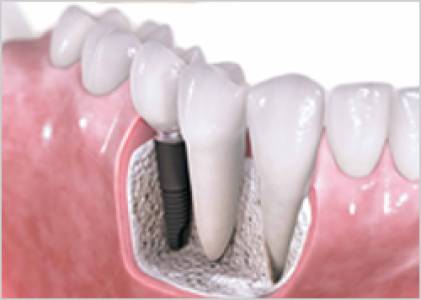 Dental Implants
