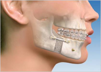 Maxillofacial Prosthetics