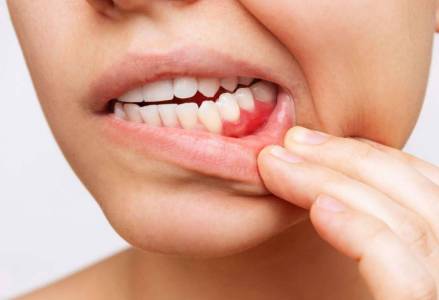 Bleeding Gums Treatment