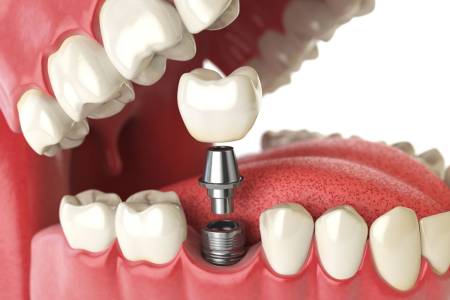 Dental Implant Fixing