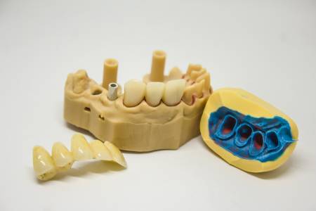 Dental Crowns and Bridges