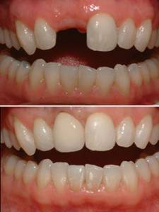 Dental Implants