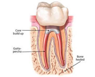 Root Canal Treatment