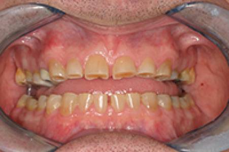 Full Mouth Rehabilitation