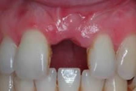 Dental implants