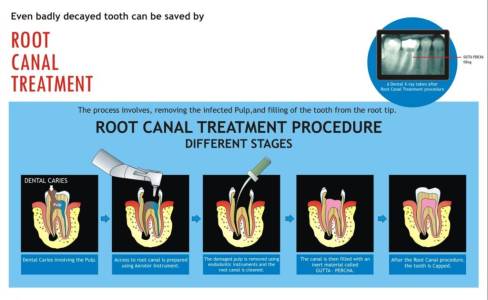 Root Canal Treatment (RCT)
