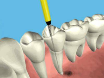 Root Canal Treatment