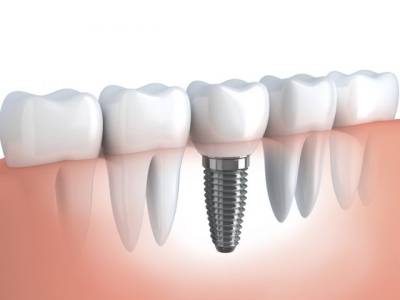 Dental Implant in Jamnagar