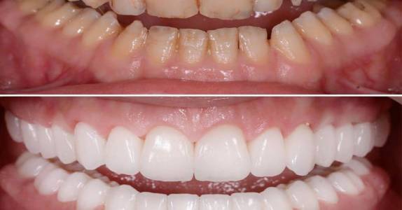 Full Mouth Rehabilitation