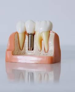 DENTAL IMPLANTS
