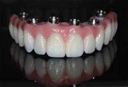Immediate dental implant ( immediate fixed teeth )