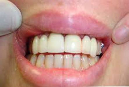 Tooth-colored fillings