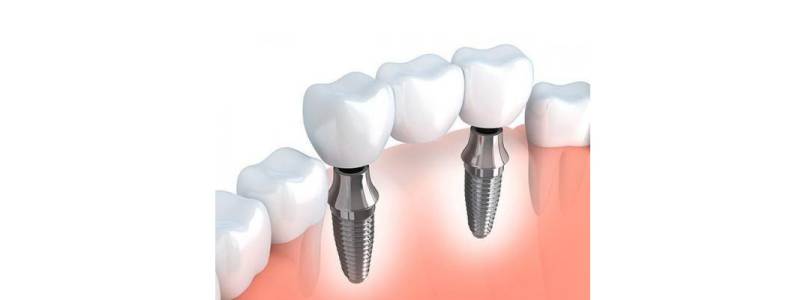DENTAL IMPLANTS